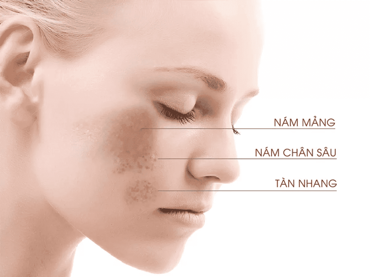 Muốn chặn đứng nám da bạn cần những chiến thuật hiệu quả để trị nám và bảo vệ da