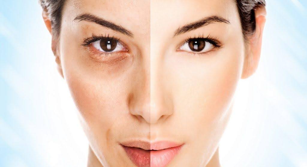 Những cách chăm sóc da mặt để trị nám, giảm thâm, loại bỏ nám tại nhà hàng ngày hiệu quả nhất