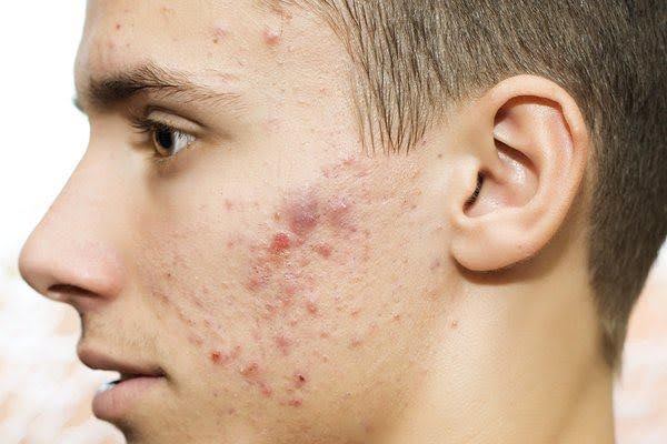 Mất bao lâu để các vết sẹo mụn trứng cá biến mất trên khuôn mặt của nam giới?