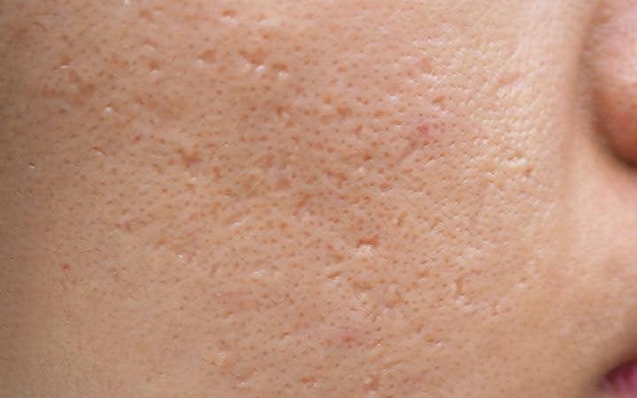Mất bao lâu để các vết sẹo mụn trứng cá biến mất trên khuôn mặt của nam giới?