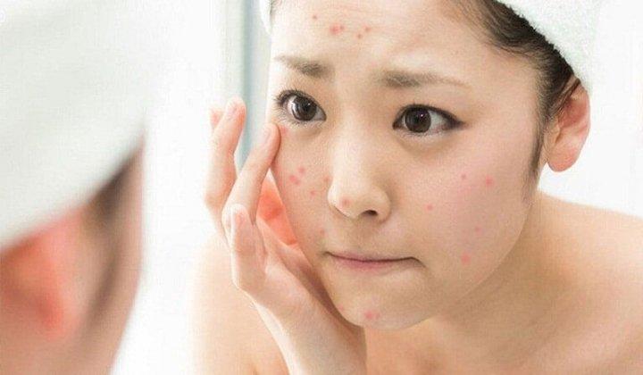 Bí kíp giải cứu làn da nhạy cảm khỏi các vấn đề kích ứng mỹ phẩm nhanh  chóng, đơn giản nhất